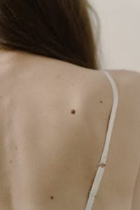 Detailed portrait of a woman's back showing skin moles and white straps in a neutral setting.